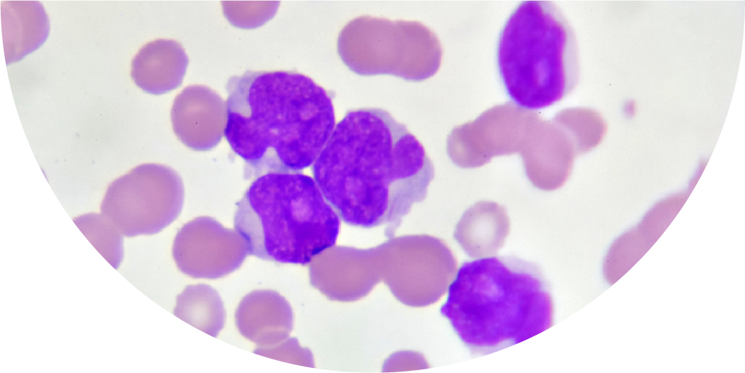 Leucemia mieloide crónica: Europa aprova medicamento para tratar crianças